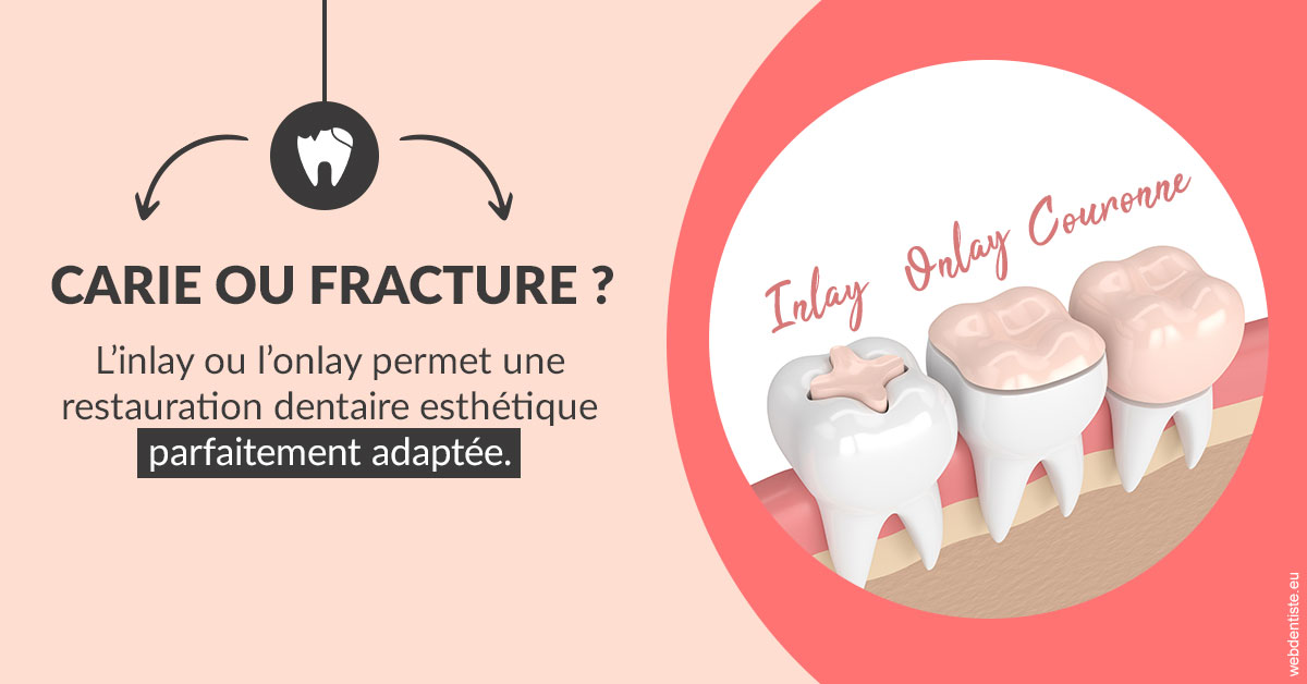 https://www.orthofalanga.fr/T2 2023 - Carie ou fracture 2