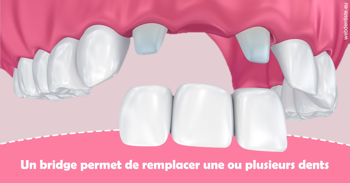 https://www.orthofalanga.fr/Bridge remplacer dents 2