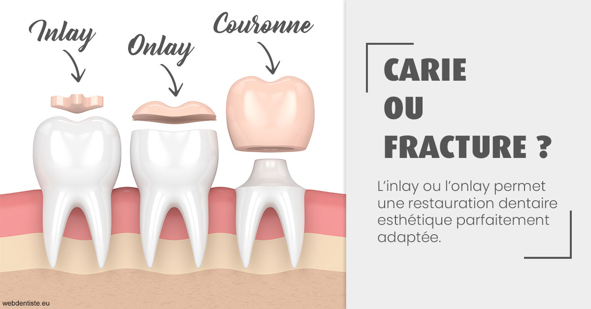 https://www.orthofalanga.fr/T2 2023 - Carie ou fracture 1