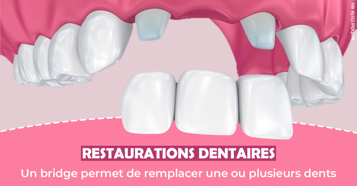 https://www.orthofalanga.fr/Bridge remplacer dents 2