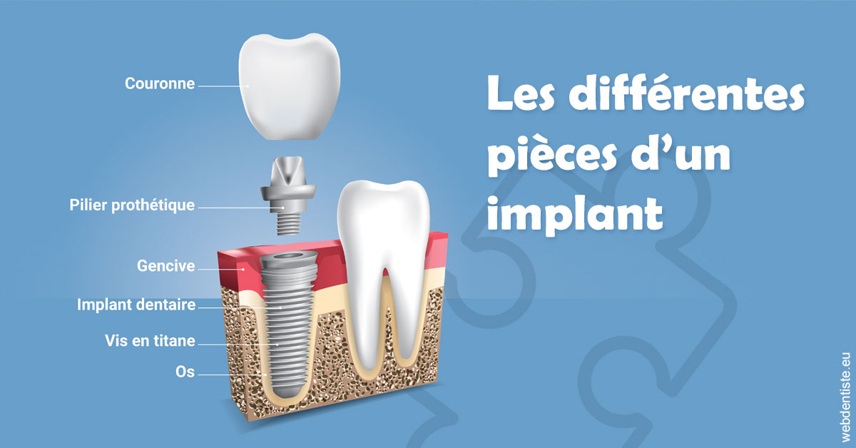 https://www.orthofalanga.fr/Les différentes pièces d’un implant 1